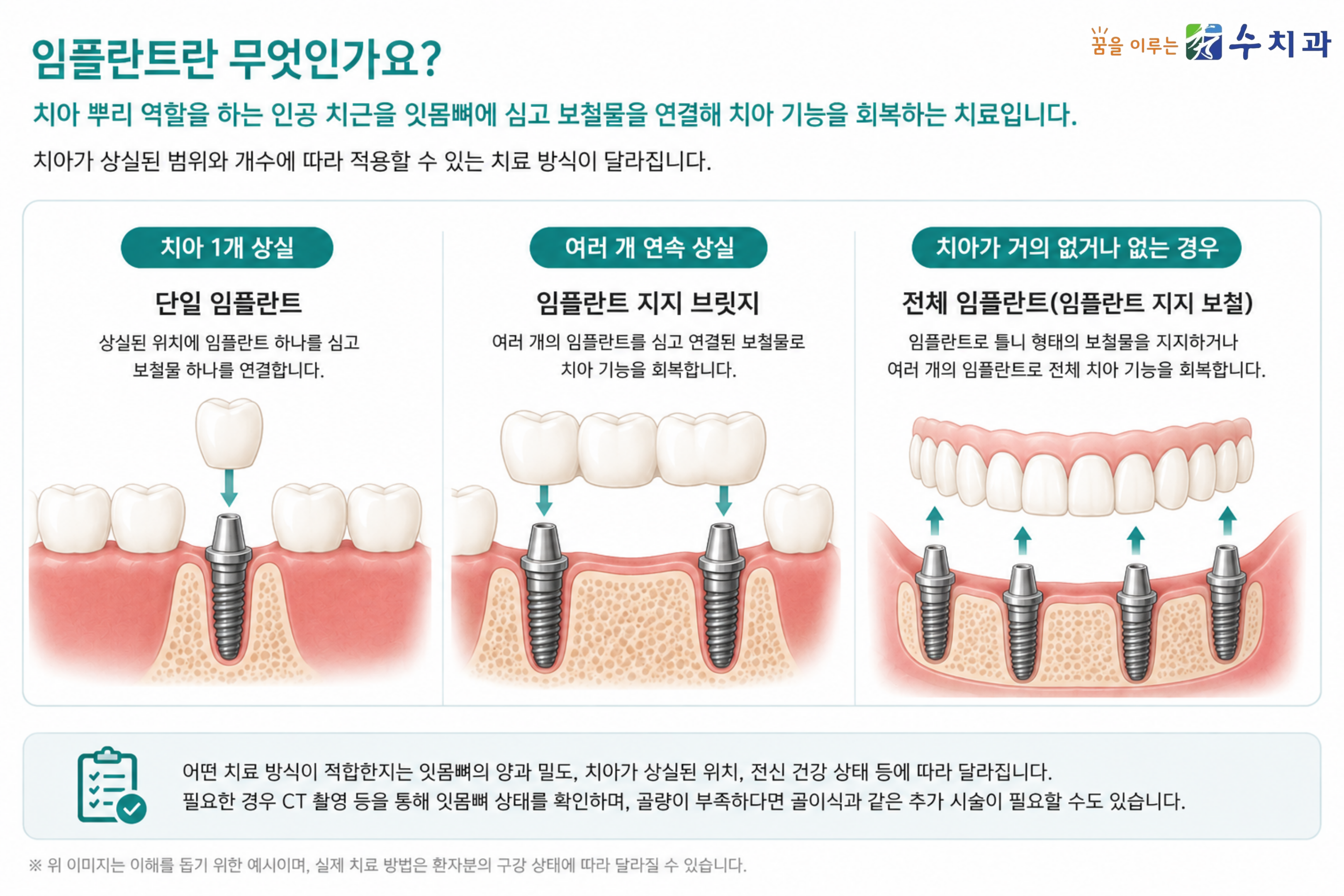 치아 상실 범위에 따른 임플란트 치료 방법