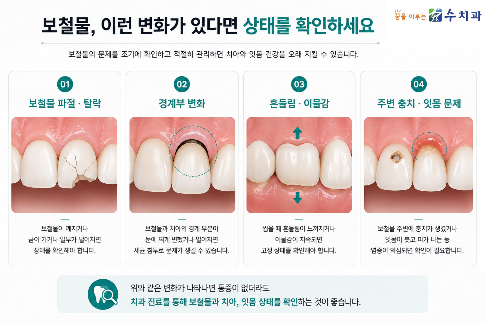보철물 파절과 경계부 변화, 흔들림, 충치와 잇몸 문제 등 보철물 상태를 확인해야 하는 경우