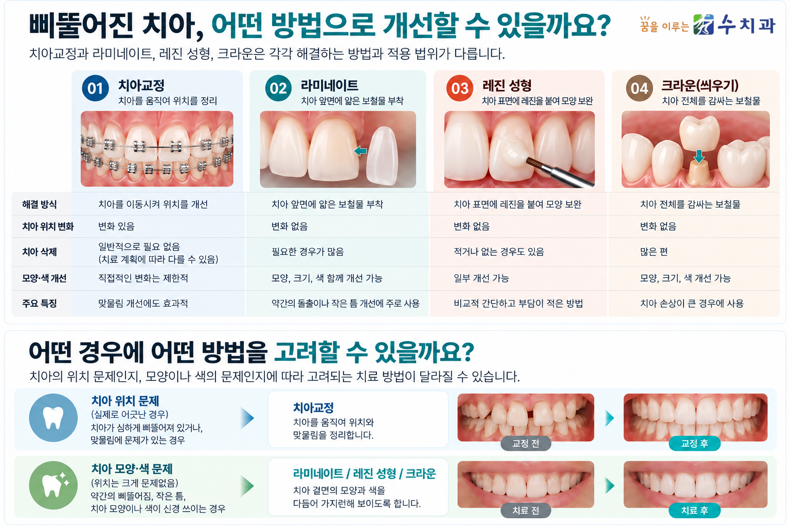 치아교정 라미네이트 레진 성형 크라운의 치료 방식과 치아 삭제 여부 및 선택 기준 비교